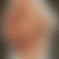 Syphilid papulöses: Historische Moulage. Abbildung entnommen aus: K. Zieler, Atlas der Haut- und ...
