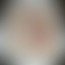 Syphilid, korymbiformes: Historische Abbildung einer Moulage. Abbildung entnommen aus: K. Zieler,...