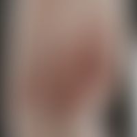 Syphilis&nbsp;connata: Historische Moulage. Abbildung entnommen aus: K. Zieler, Atlas der Haut- u...