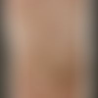 Differenzialdiagnose Psoriasis palmo-plnataris: Papulo-squamöses Syphilid. Historische Moulage. A...