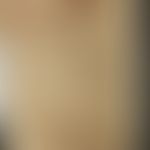 Syphilid varioliformes: Historische Moulage. Abbildung entnommen aus: K. Zieler, Atlas der Haut- ...