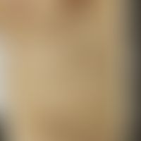 Syphilid varioliformes: Historische Moulage. Abbildung entnommen aus: K. Zieler, Atlas der Haut- ...
