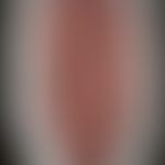 Differenzialdiagnose: lingua plicata. Diagnose: lingua syphilitica gummosa. Historische Moulage. ...