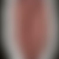 Differenzialdiagnose: lingua plicata. Diagnose: lingua syphilitica gummosa. Historische Moulage. ...