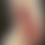 Differenzialdiagnose: Karzinom der Haut. Syphilitische Gummen:Historische Moulage. Abbildung entn...