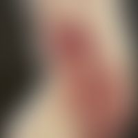 Differenzialdiagnose: Karzinom der Haut. Syphilitische Gummen:Historische Moulage. Abbildung entn...