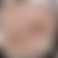 Zoster: Historische Moulage. Abbildung entnommen aus: K. Zieler, Atlas der Haut- und Geschlechtsk...