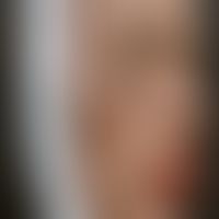 Syphilis connata: Sattelnase&nbsp;-&nbsp;Historische Moulage. Abbildung entnommen aus: K. Zieler,...
