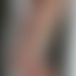 Differentialdiagnose Pemphigoide: Syphilis pemphigoides des Säuglings: Historische Moulage. Abbil...