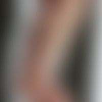 Differentialdiagnose Pemphigoide: Syphilis pemphigoides des Säuglings: Historische Moulage. Abbil...