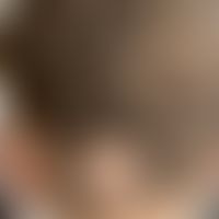 Differenzialdiagnose Alopecia areata. Diagnose: Mikrosporie.&nbsp;Historische Moulage. Abbildung ...