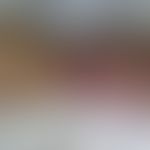 Chronisch rezidivierende anuläre neutrophile Dermatose:&nbsp;scharf begrenzte feste, schmerzhafte...