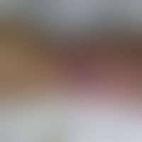 Chronisch rezidivierende anuläre neutrophile Dermatose:&nbsp;scharf begrenzte feste, schmerzhafte...