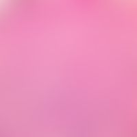 Chronisch rezidivierende anuläre neutrophile Dermatose: Dichte überwiegend neutrophile Infiltrati...