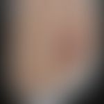 Sporotrichose/Historische Moulage:&nbsp;Abbildung entnommen aus: K. Zieler, Atlas der Haut- und G...
