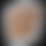 Sporotrichose/Historische Moulage: Abbildung entnommen aus: K. Zieler, Atlas der Haut- und Geschl...