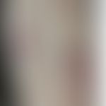 Differenzialdiagnose - Ekthyma. Diagnose: Sporotrichose.&nbsp;Historische Moulage. Abbildung entn...