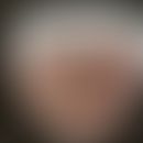 Syphilis/Primäraffekt: Historische Moulage. Abbildung entnommen aus: K. Zieler, Atlas der Haut- u...