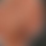 Scharlach: Historische Moulage. Abbildung entnommen aus: K. Zieler, Atlas der Haut- und Geschlech...