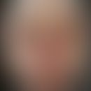 Malleus chronicus: Historische Moulage. Abbildung entnommen aus: K. Zieler, Atlas der Haut- und G...