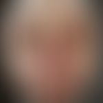 Malleus chronicus: Historische Moulage. Abbildung entnommen aus: K. Zieler, Atlas der Haut- und G...