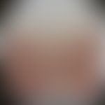 Lupus erythematodes chronicus discoides: Historische Moulage. Abbildung entnommen aus: K. Zieler,...