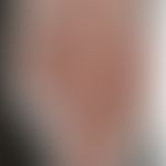 Lupus erythematodes chronicus discoides: Historische Moulage. Abbildung entnommen aus: K. Zieler,...