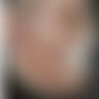 Differenzialdiagnose Tinea barbae: Diagnose: Tuberculosis cutis luposa:&nbsp;Historische Moulage....