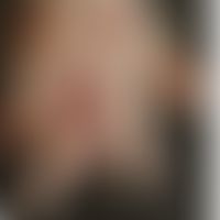 Differenzialdiagnose Lepra lepromatosa- Diagnose: Tuberculosis cutis luposa:&nbsp;Historische Mou...