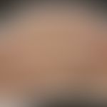 Lepra tuberosa (facies leontina):&nbsp;Historische Moulage. Abbildung entnommen aus: K. Zieler, A...