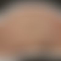 Lepra tuberosa (facies leontina):&nbsp;Historische Moulage. Abbildung entnommen aus: K. Zieler, A...