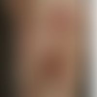 Differenzialdiagnose: Sporotrichose - Diagnose: Anthrax:&nbsp;&nbsp;Historische Moulage. Abbildun...
