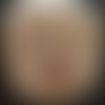 Diphtherie der Haut: Historische Moulage. Abbildung entnommen aus: K. Zieler, Atlas der Haut- und...