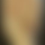 Diphtherie der Haut: Historische Moulage. Abbildung entnommen aus: K. Zieler, Atlas der Haut- und...