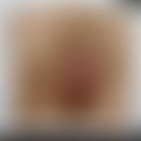 Herpes simplex genitalis: Historische Moulage. Abbildung entnommen aus: K. Zieler, Atlas der Haut...