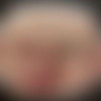 Lupus pernio: Historische Moulage. Abbildung entnommen aus: K. Zieler, Atlas der Haut- und Geschl...