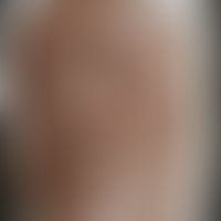 Lepra lepromatosa: Historische Moulage. Abbildung entnommen aus: K. Zieler, Atlas der Haut- und G...