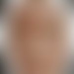 Impetigo contagiosa: Historische Moulage. Abbildung entnommen aus: K. Zieler, Atlas der Haut- und...