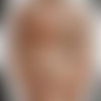Impetigo contagiosa: Historische Moulage. Abbildung entnommen aus: K. Zieler, Atlas der Haut- und...
